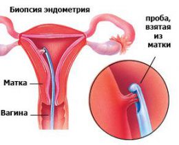 Биопсия эндометрия - Пайпель