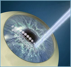 Лазерная коррекция зрения методом Фемто ЛАСИК (Femto LASIK)