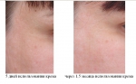 Кожа в уголках глаз до и после использования крема