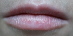 губы с повреждениями после проф.чистки зубов