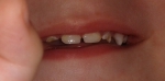 Раскрошившиеся зубки
