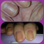 Фото сверху - ломкие ногти. Фото ниже - ногти после курса Кальци - К1.