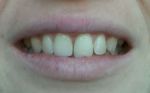 на фото мои зубы белее, чем в жизни