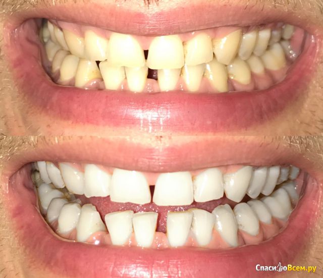 Отбеливающие полоски Youniverse Teeth Whitening Strips