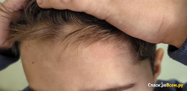 Микрополяризация головного мозга